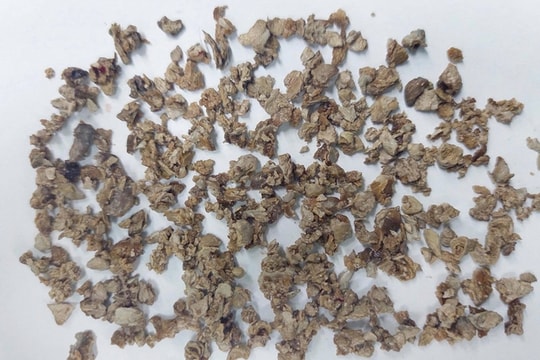 Phẫu thuật thành công ca sỏi thận san hô phức tạp sau 10 năm bệnh nhân tự điều trị bằng thuốc nam