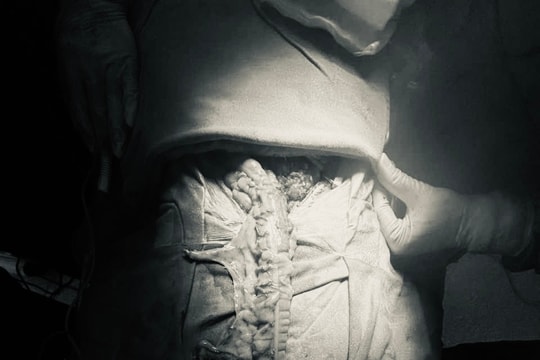 Bệnh nhân từng cắt thực quản, nay tiếp tục được tái tạo bằng đại tràng