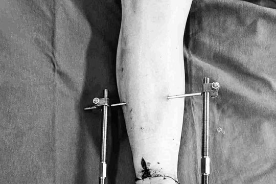 Nối thành công bàn chân đứt lìa sau tai nạn máy cắt cỏ