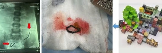 Bé trai 5 tuổi nuốt 20 viên nam châm, thủng ruột 8 lỗ