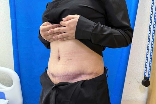 Bác sĩ cảnh báo hậu quả đáng lo sau tiêm trị sẹo bụng