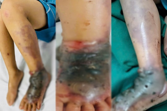 Đắp thuốc nam chữa vết mèo cào, bé trai 4 tuổi nhập viện nguy kịch