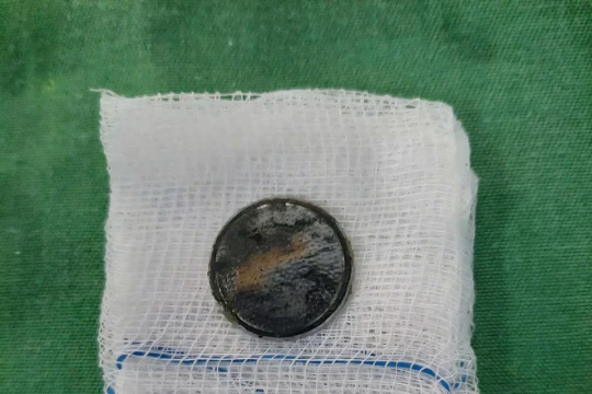 Bác sĩ cảnh báo nguy cơ tử vong do nhiều trẻ nuốt, nhét pin 'cúc áo'