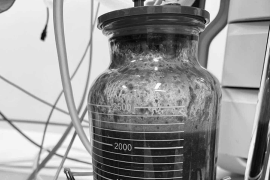 Nữ bệnh nhân 35 tuổi nguy kịch sau 5 năm tiêm silicon nâng ngực tại cơ sở tư nhân