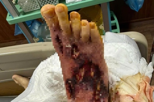 Vết xước tưởng vô hại, bệnh nhân 80 tuổi đối mặt nguy cơ mất bàn chân