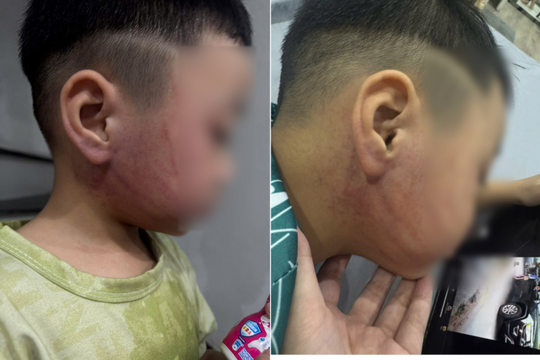 Xác minh vụ bé 4 tuổi nghi bị cô giáo đánh bầm tím mặt