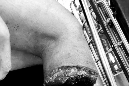 Cẳng chân gần lìa khỏi cơ thể, nam sinh 15 tuổi được bác sĩ cứu ngoạn mục