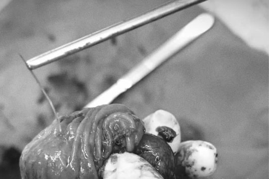 Xương cá 4 cm đâm thủng ruột non, người đàn ông 33 tuổi suýt tử vong