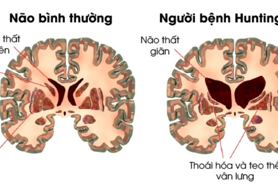 Lần đầu tiên điều trị thành công bệnh di truyền múa giật Huntington