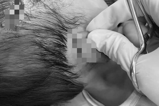 Bé gái 19 tháng tuổi bị chó cắn nguy kịch, phải tiêm huyết thanh kháng dại