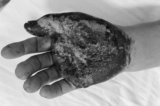 Nguy cơ mất bàn tay vì tin vào lá thuốc dân gian