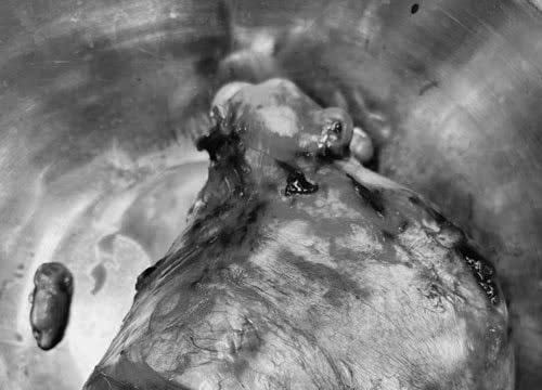 Cắt bỏ khối u xơ tử cung gần 3kg ở nữ bệnh nhân 47 tuổi