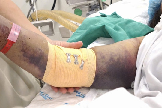 Mưa lũ muỗi sinh sôi, bệnh viện cảnh báo ca sốt xuất huyết Dengue nặng tăng nhanh