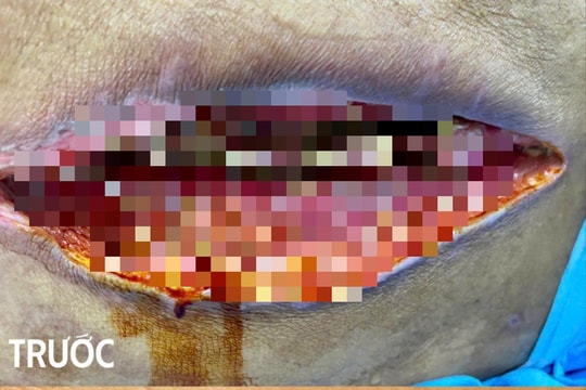 Vết mổ lộ xương, phổi trắng xóa do vi khuẩn kháng thuốc