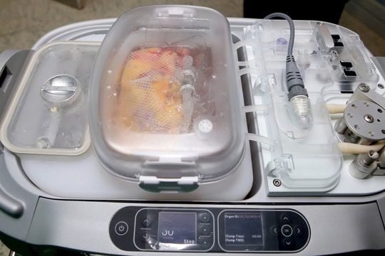 Ca ghép thận bằng HMP LifePort đầu tiên tại Việt Nam thành công ngoài mong đợi