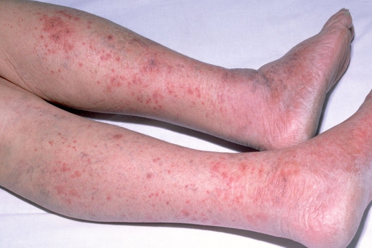 TP HCM cảnh báo khẩn bệnh tấn công chớp nhoáng, có thể cướp đi sinh mạng chỉ trong vài giờ