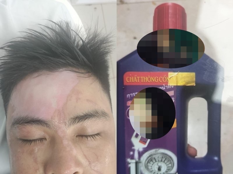 Nhiều trường hợp bỏng nặng khi sử dụng chất thông cống siêu tốc