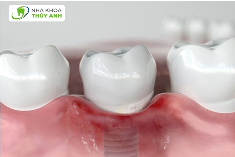 Trồng răng implant giá rẻ thủ phạm tàn phá sức khỏe răng miệng