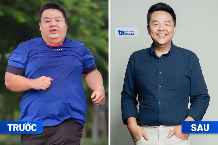 Thoát “bụng bia” nhờ giảm cân chuẩn y khoa