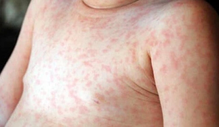 Quảng Nam: Phần lớn các ca mắc sởi chưa được tiêm vắc xin