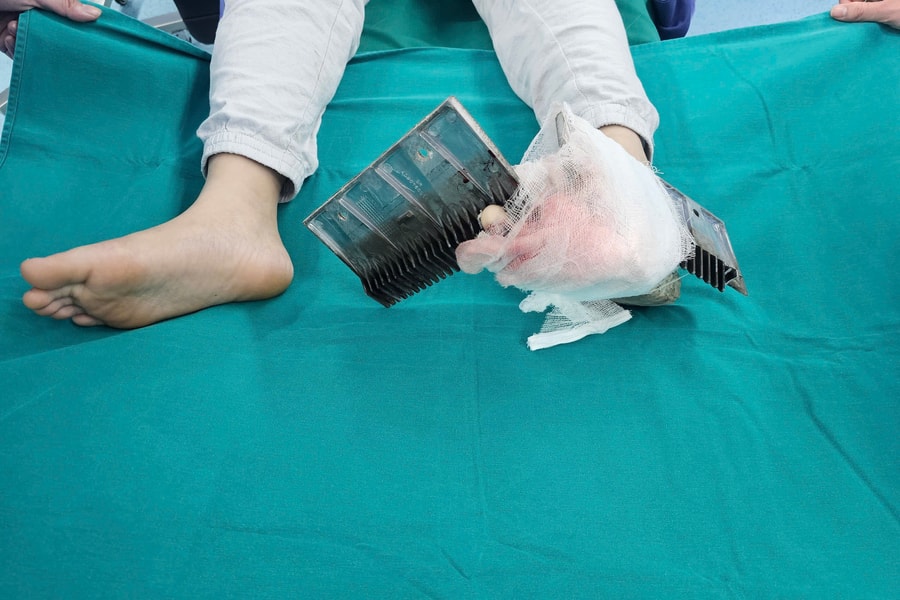 Bị thang cuốn kẹp vào chân, bé trai Hà Nội phải mổ cấp cứu