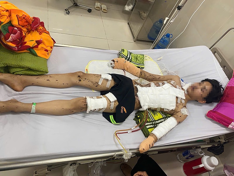 Pháo tự chế phát nổ, nam sinh mất bàn tay và tổn thương nghiêm trọng