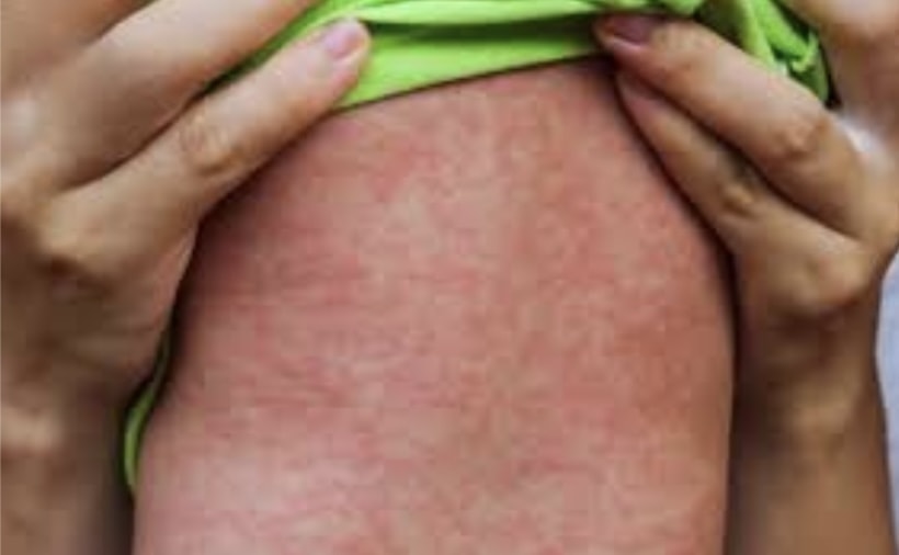 Hà Nội: Ghi nhận một trường hợp tử vong do mắc bệnh sởi