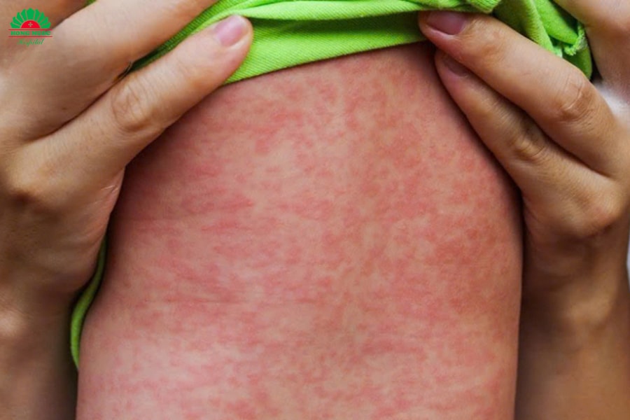 Sởi vào chu kỳ bùng phát 5 năm 1 lần: Cảnh báo nhiều trẻ biến chứng nặng