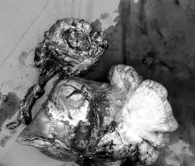 Phẫu thuật thành công khối u ruột non gần 4kg sau 4 năm sống chung với bệnh