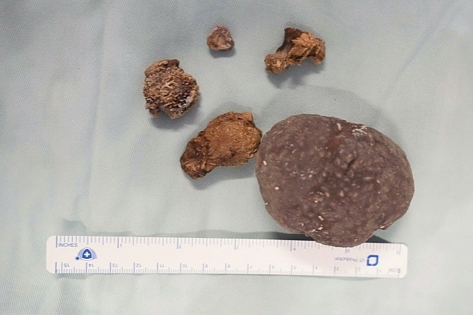 Bệnh nhân 64 tuổi mất thận vì chủ quan với sỏi thận kéo dài