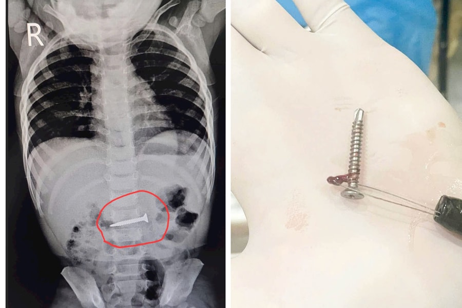 Phú Thọ: Bé gái 19 tháng tuổi thoát nạn sau khi nuốt phải đinh vít dài 2cm