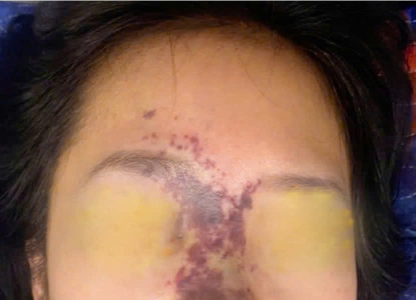 Biến chứng nặng khi làm đẹp tại các cơ sở thẩm mỹ không đảm bảo an toàn