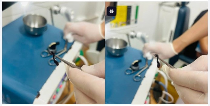 Phát hiện đỉa rừng trong mũi cháu bé hơn 2 tuổi