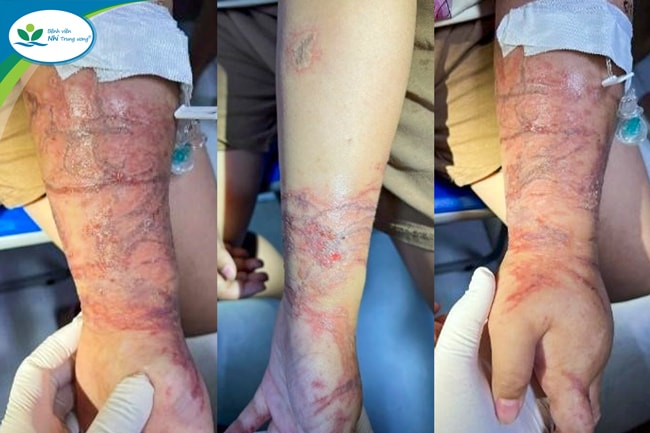 Cảnh báo mùa du lịch biển: Viêm da tiếp xúc do sứa biển