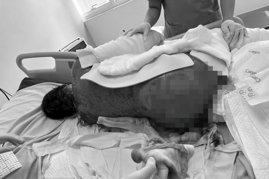 Cứu người phụ nữ mắc bệnh lý hiếm gặp, tổn thương da 92%