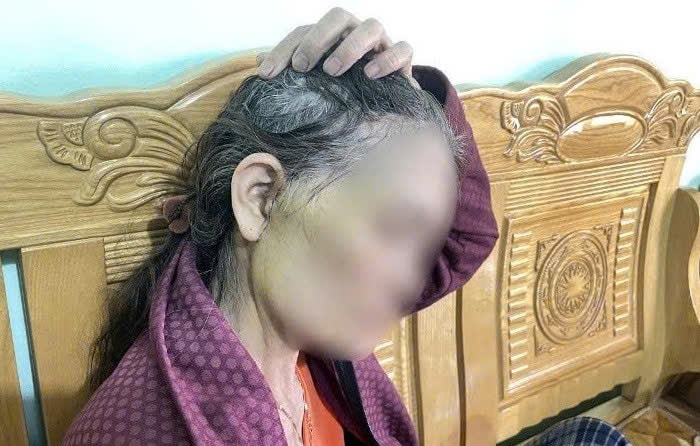 Gia Lai: Nữ bệnh nhân U70 gặp biến chứng sau khi phẫu thuật căng da mặt