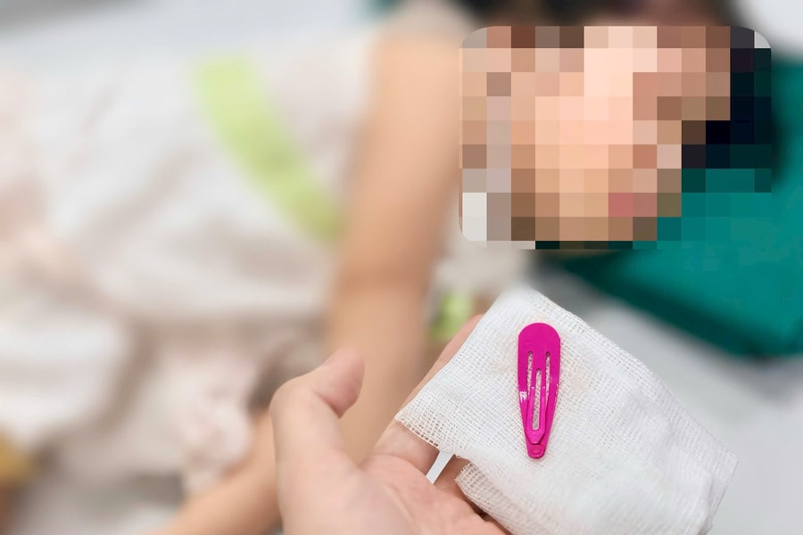 Gắp thành công dị vật kẹp tóc dài 5cm trong dạ dày bé gái 21 tháng tuổi