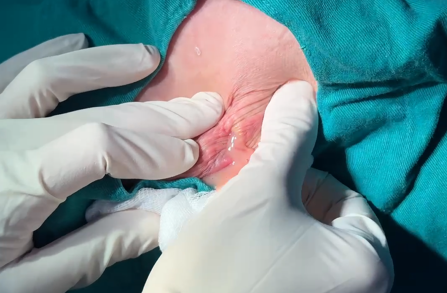 Bị biến chứng sau khi nâng mông độn silicon tại cơ sở thẩm mỹ tư nhân