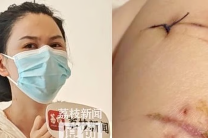 Sống sót kỳ diệu sau 22 nhát dao nhờ túi nâng ngực