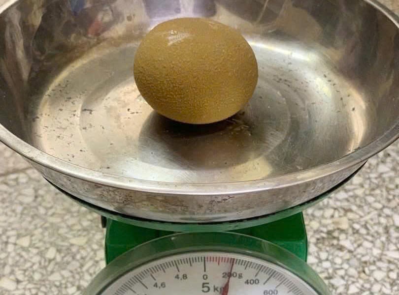 Người đàn ông mang viên sỏi bàng quang bằng quả cam suốt nhiều năm