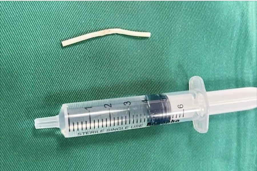 Nhập viện do que cấy tránh thai 'đi lạc' trong cánh tay