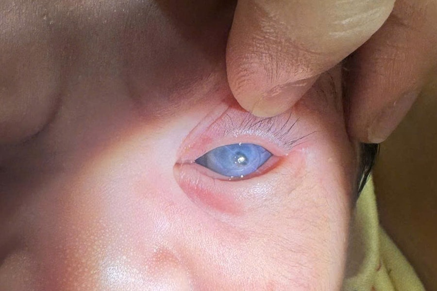 Bệnh glocom ở trẻ em nguy hiểm thế nào?