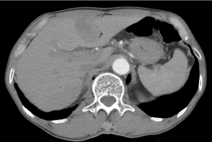 Sỏi mật có thể gây ung thư nếu không được điều trị sớm