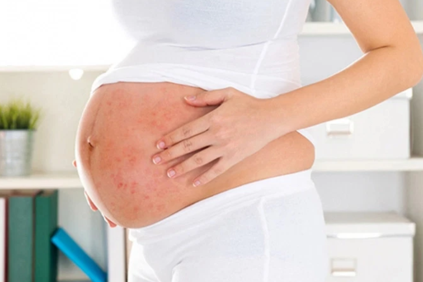 Mắc sởi khi mang bầu, nguy hiểm đối với cả mẹ và con