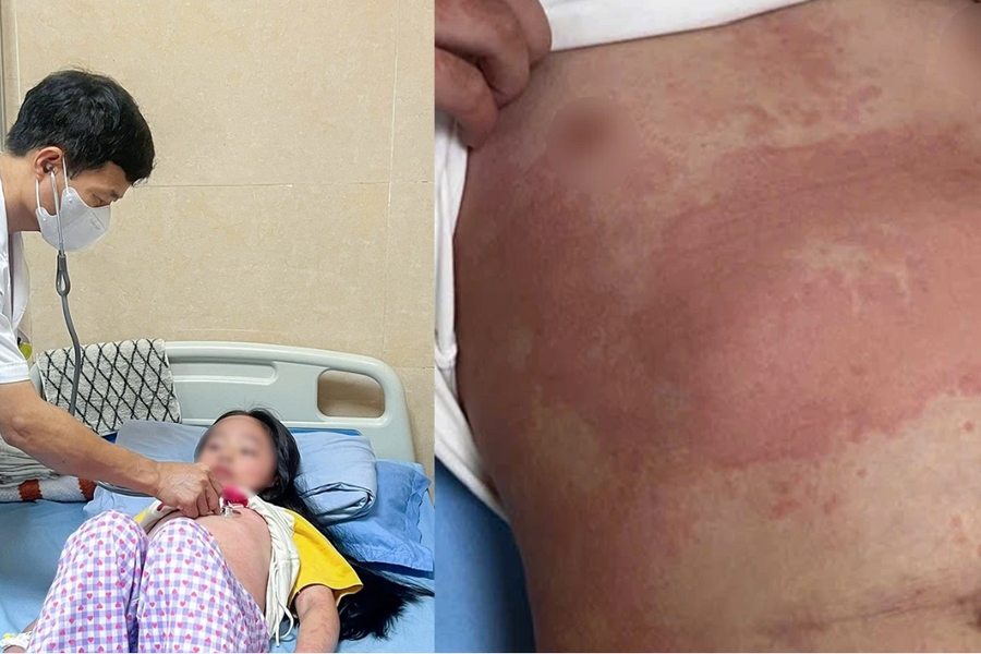 Phú Thọ: Nhiều trẻ nhập viện vì ban nhiễm khuẩn