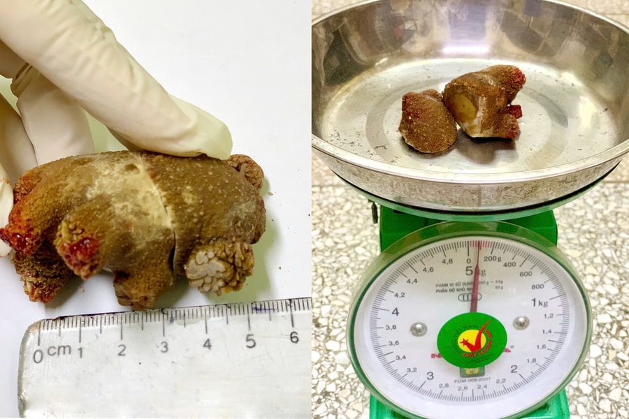 Phát hiện sỏi thận ‘khổng lồ’ như san hô sau gần 20 năm âm thầm phát triển