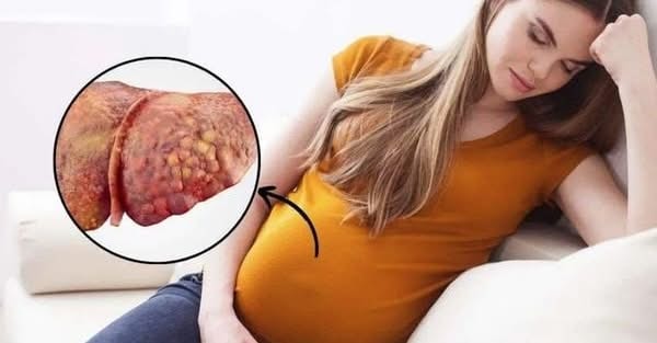 Thoát "cửa tử" sau khi được thay gần như toàn bộ máu: Sản phụ nguy kịch vì gan nhiễm mỡ cấp thai kỳ