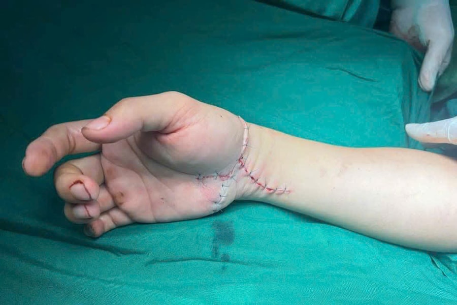 Nối thành công bàn tay bị chém đứt lìa cho nam Tiktoker ở Thái Nguyên
