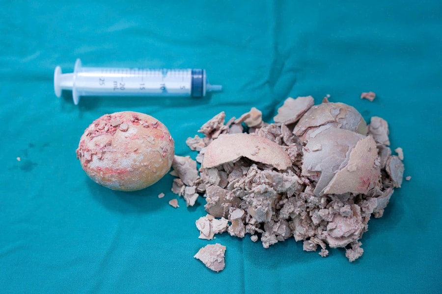 Gia Lai: Viên sỏi khổng lồ dài hơn 10cm trong bàng quang bệnh nhân 36 tuổi