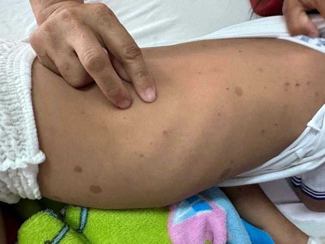 Bé gái 7 tuổi bị ong đốt gần 200 vết, tổn thương giác mạc khi theo bố mẹ lên rẫy